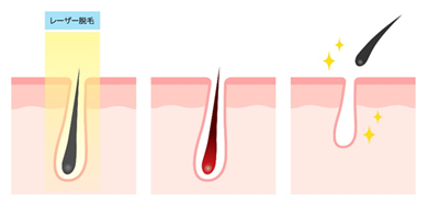 医療レーザー脱毛